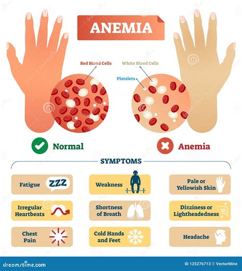 Anemia Vector Illustration Labeled Scheme With Red Blood Cells Stock