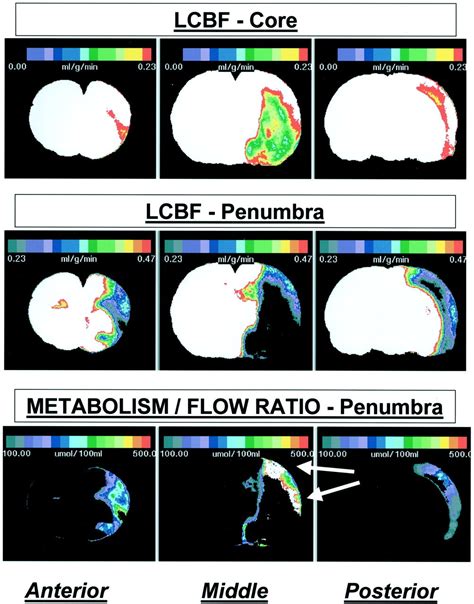 Adventures In The Pathophysiology Of Brain Ischemia Penumbra Gene