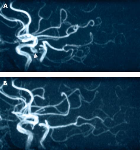 Intracranial aneurysm: seen and unseen | Journal of Neurology ...