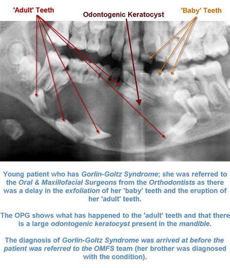 Odontogenic Keratocyst Radiology