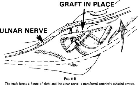 Figure 3 From Reconstruction Of The Ulnar Collateral Ligament In Athletes Semantic Scholar