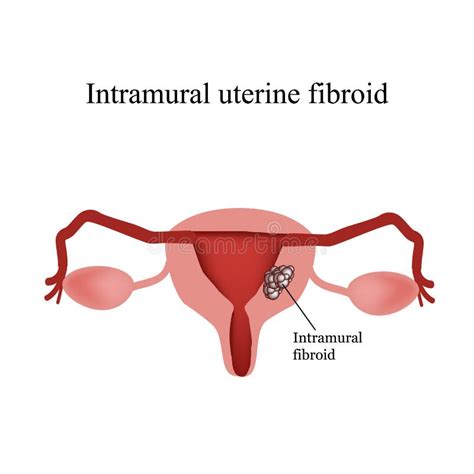 Uterine Fibroids Stock Illustrations 177 Uterine Fibroids Stock