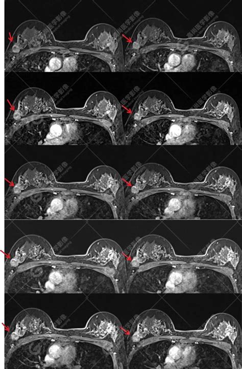 病理证实磁共振平扫 动态增强诊断乳腺浸润性导管癌1例 知乎