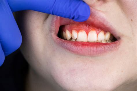 Qu Es La Guna Cl Nica Dental Los Arcos