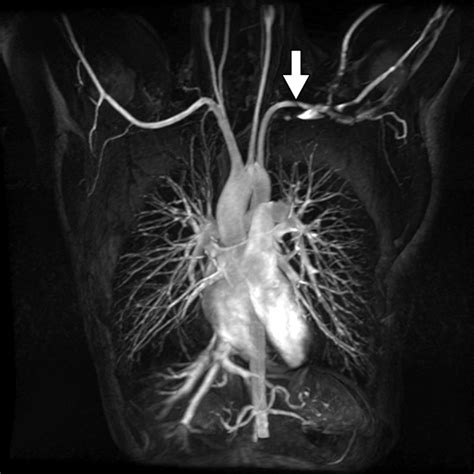 Vascular Thoracic Outlet Syndrome Protocol Design And Diagnostic Value