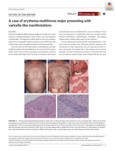 Erythema Multiforme Major