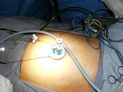 Single Incision Laparoscopic Surgery Sils Centre Singapore