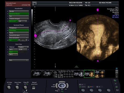 Ge Voluson S8 Ultrasound Machine Prices And Specs Ultrasound Supply