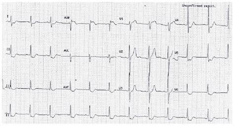 Ecg Showing St Elevation In Avr V1 With Upright T Wave In Lead Avl Download Scientific