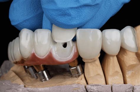 Dental Crowns Risks Dangers And How To Minimize Them