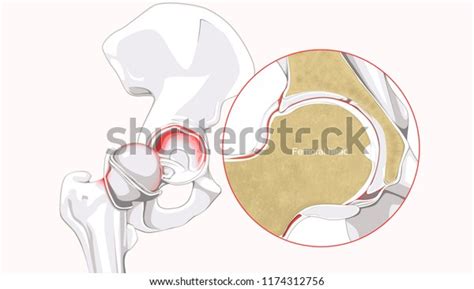 Labral Tearstorn Labrum Hip Stock Illustration 1174312756