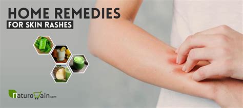 10 Simple and Best Home Remedies for Skin Rashes