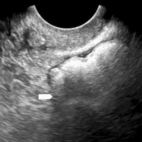 Ultrasound Example Of Bowel Grayscale Transvaginal Ultrasound Image Of