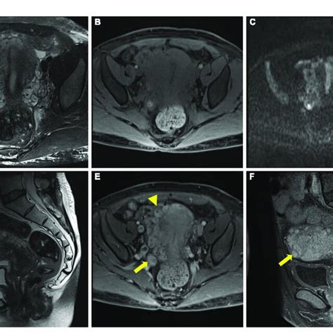 Pelvic Magnetic Resonance Imaging Mri Image A C Multiple Tortuous Download Scientific