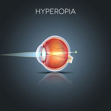 Hyperopia Long Sighted Eye Stock Vector Illustration Of Glass Eyes 52790998