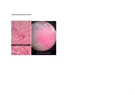 Patología inflamación aguda crónica granulomatosa y cicatrización