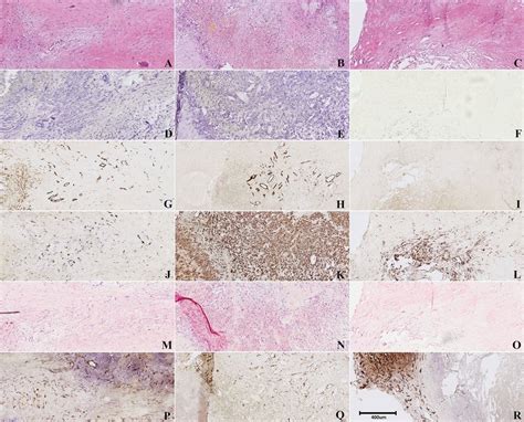 Representative Examples Of Histologic Parameters Of Hot Spots Of A