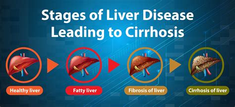 Stages Of Liver Disease Educational Banner Vector Art At Vecteezy