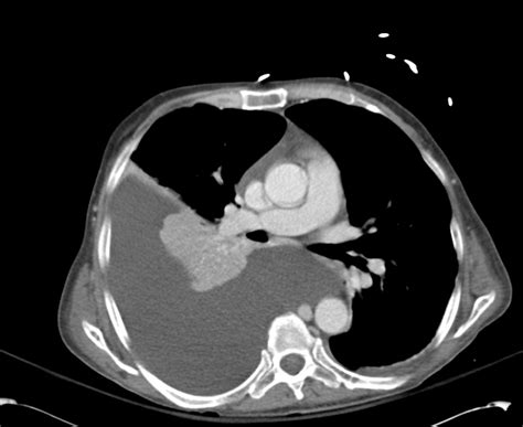 Ctap 0004 Pleural Effusion Differential Diagnosis Of