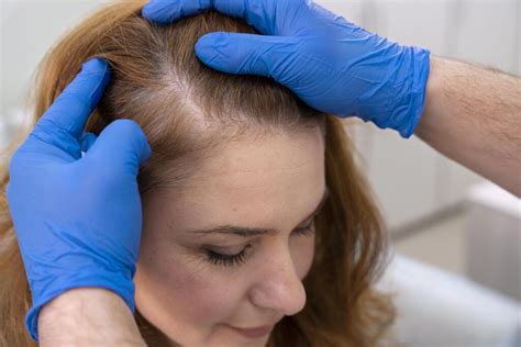 Hair Loss Treatments Lotus Healthcare And Aesthetics