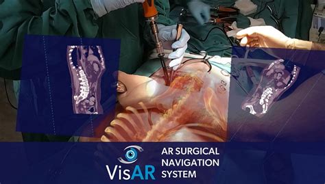 First Fully Immersive 3d Augmented Reality Surgical Navigation System Achieves Fda Approval For