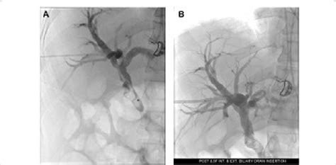 A Cholangiogram Showing IHBRD Dilated CBD And Filling Defects Seen