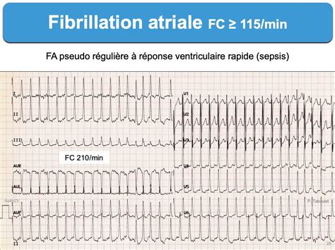 Qu Est Ce Que La Fibrillation Auriculaire FA