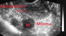 Miomas Uterinos Dr Jos Mar A Mu Oz Conde Ginec Logo En Carmona