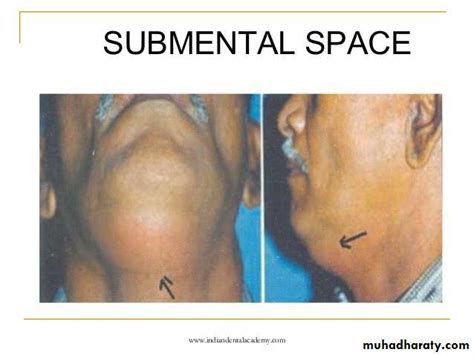 Fascial Spaces Pptx دكتور نجاة نظري Muhadharaty