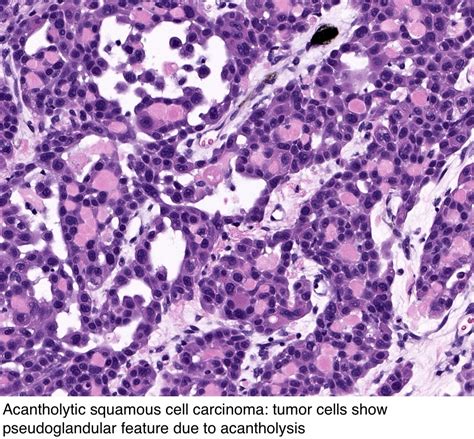 Pathology Outlines Squamous Cell Carcinoma