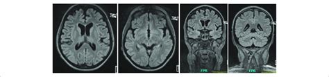 Cerebral Magnetic Resonance Cmri Imaging Showing Generalized