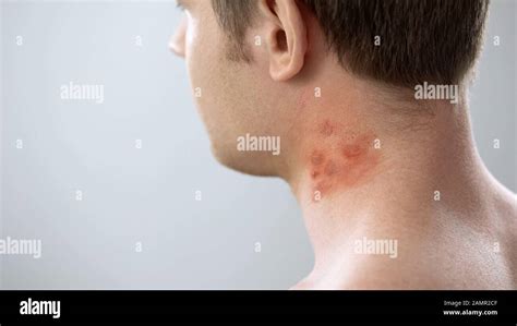 Psoriasis Itch Banque Dimage Et Photos Page 4 Alamy