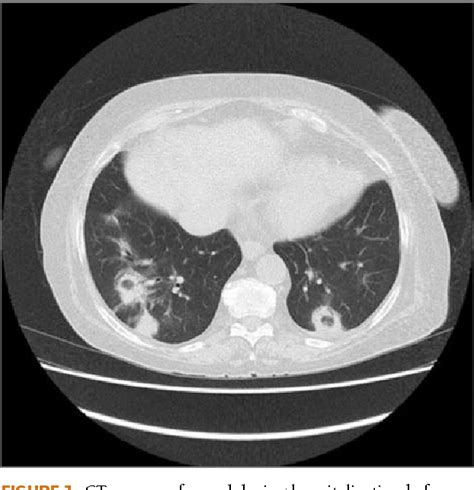 Reversed halo sign in organizing pneumonia secondary to rheumatoid arthritis. | Semantic Scholar