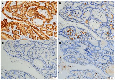 Immunohistochemical Staining For Mucin Phenotypes The Tumor Cells Were