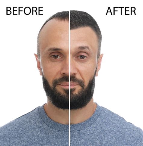 Minoxidil Before And After Beard