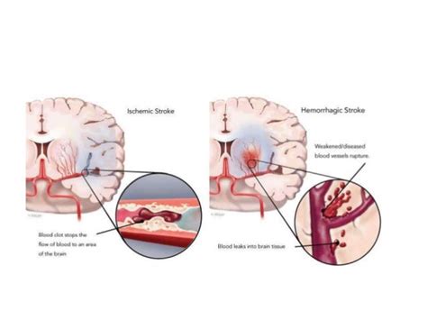 Basal ganglia stroke