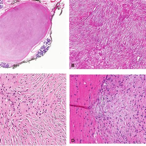 Histologic Findings Of Lgfms A Panoramic View Of A Well Defined Download Scientific Diagram