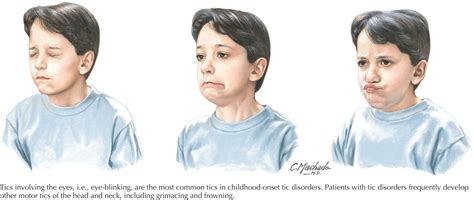 Tic Disorders - Clinical Tree