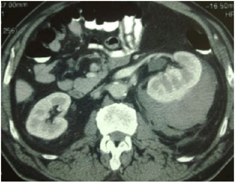 Figure 1 From Spontaneous Subcapsular Renal Hematoma In A Patient Being