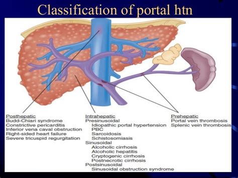 Portal Hypertensionclassification And Pathophysiology