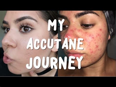 Accutane Week Starting Accutane My Acne Journey Youtube