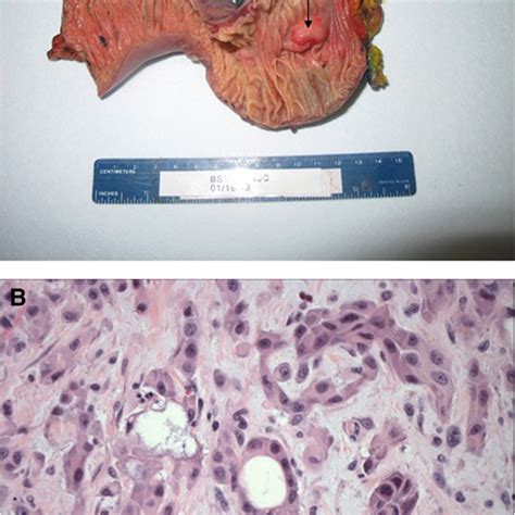 Adenosquamous Carcinoma Of The Ampulla Of Vater A Gross Image Of Download Scientific Diagram