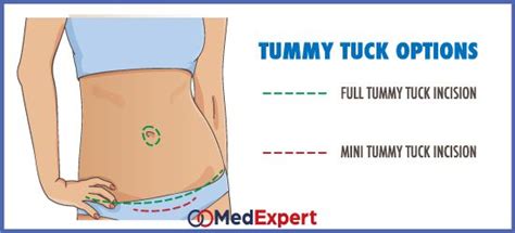 Types Of Tummy Tuck Surgery Mini Tummy Tuck Tummy Tuck Surgery Tummy Tucks