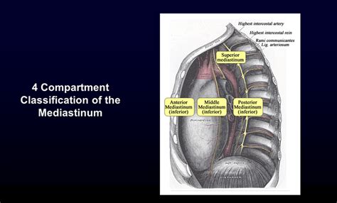 Robotic Surgery Of The Mediastinum A Review