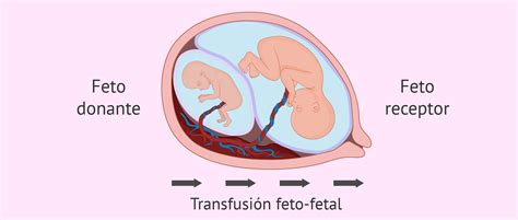 S Ndrome De Transfusi N Feto Fetal