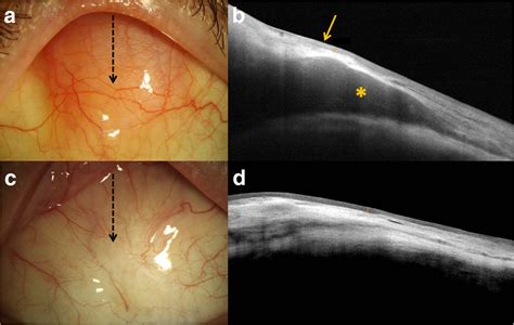 Classification Diagnosis And Management Of Conjunctival Lymphoma Springerlink