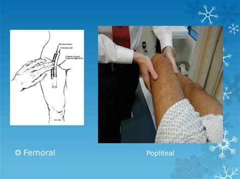 Femoral Pulse Palpation