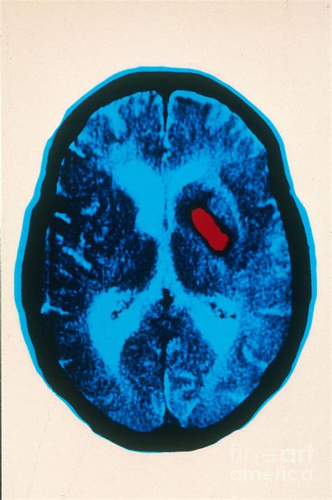 Hemorrhagic Stroke, Ct Scan Photograph by Scott Camazine - Fine Art America