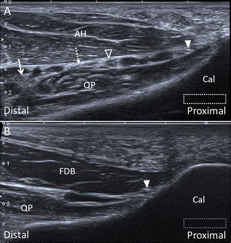 Median Nerve Ultrasound