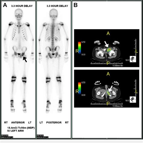 Nuclear Medicine Imaging Technetium 99m Methyl Diphosphonate Tc